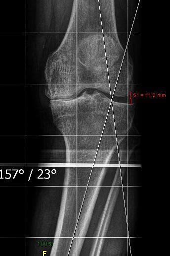 Knee Joint Preservation Surgery Including High Tibial Osteotomy