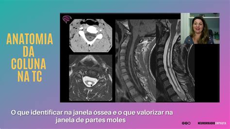 Anatomia Da Coluna Cervical E Lombar Na Tomografia Computadorizada