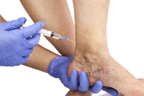 The Risks Of Ignoring Your Varicose Veins Physicians