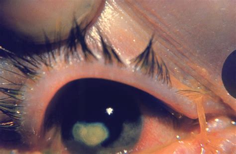 White Spot On Eye Causes Symptoms And Treatment