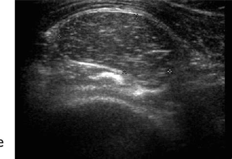 Figure 1 From Ultrasound Of Soft Tissue Masses Semantic Scholar