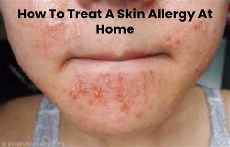 Skin Allergy Home Remedies The Glamour Media 2022