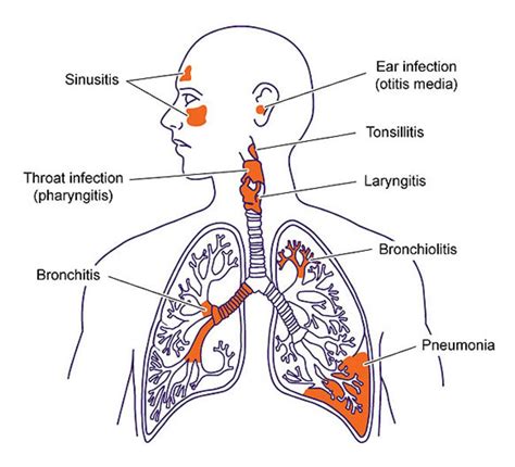 Respiratory Tract Infection Rti Is Defined As Any Inf Upper