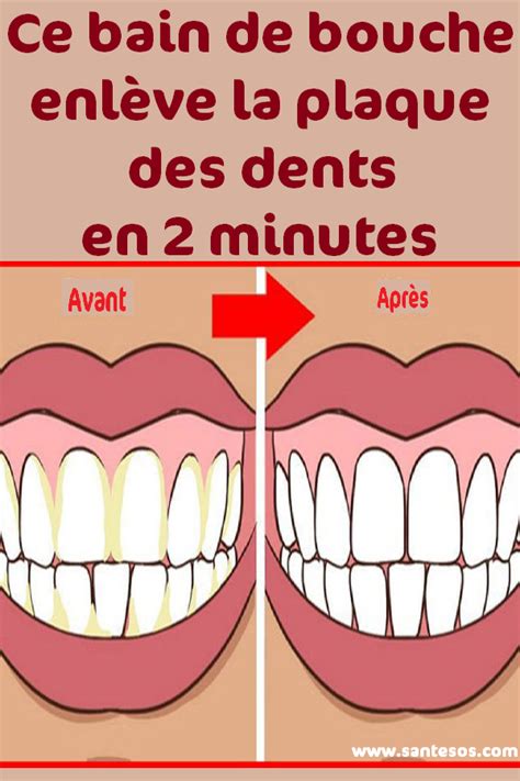 Ce Bain De Bouche Enl Ve La Plaque Des Dents En Minutes Bain De Bouche Nettoyage Dentaire