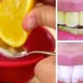 Gum Bleaching Home Remedies