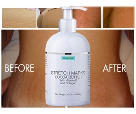 Best Scar Removal Cream Forold Scars Stretch Mark Removal Cream For Men