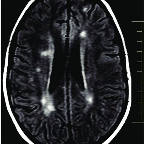 Brain Mri Showing Multiple Infratentorial Lesions Download
