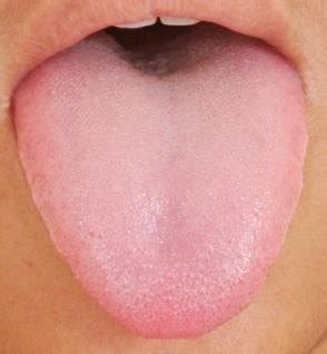 Normal Healthy Tongue Photo The Health Coach