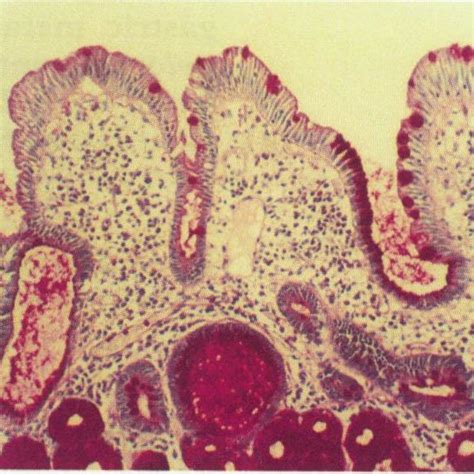 Duodenal Bulb Biopsy Specimen Showingfoci Of Gastric Metaplasia