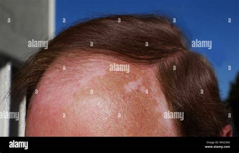Get Sunburned Hi Res Stock Photography And Images Alamy
