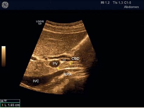 Normal Sized Lymph Node Next To The Cystic Duct Cystic Duct Cd Lymph