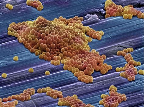 Mrsa Methicillin Resistant Staphylococcus Serious Even Fatal