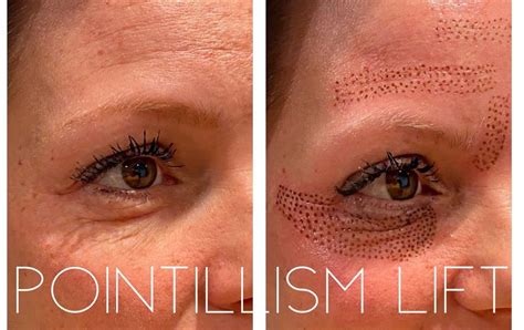 Plasma Fibroblast Under Eyes Under Eye Wrinkles Skin Tightening