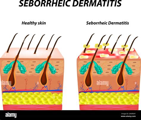 Seborrhea Skin And Hair Dandruff Seborrheic Dermatitis Eczema