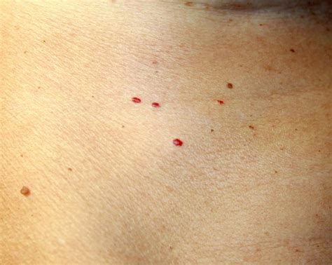 What Causes Red Dots On My Skin Quora
