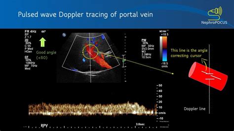 Basics Of Doppler Ultrasound For The Nephrologist Part Renal