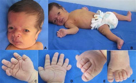 Macrocephaly Capillary Malformation Syndrome Causes Symptoms