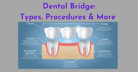 What Is A Dental Bridge Types Procedures And More Dental Insurance