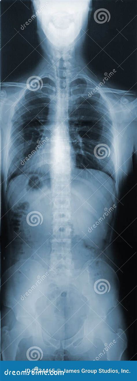 X Ray Of The Torso Stock Image Image Of Orthopaedic Arthritis 2234465