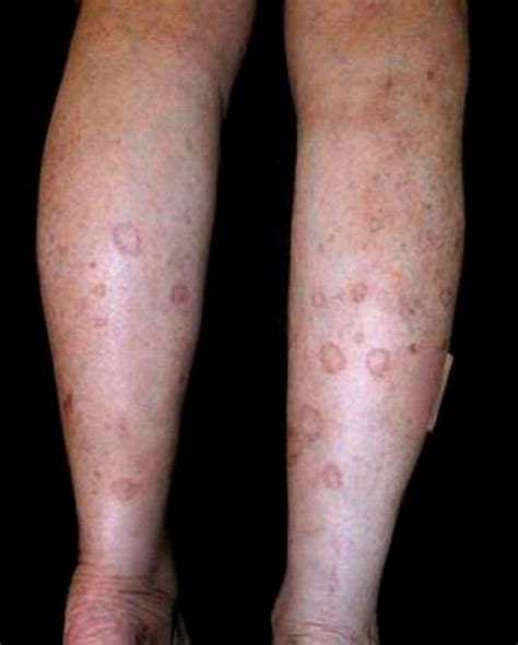 A Patient Suffering From Disseminated Superficial Actinic Porokeratosis