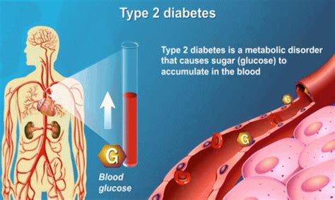 Do you or someone you know suffer from diabetes? Step By Step Plan To Take Control Of Type 2 Diabetes ...