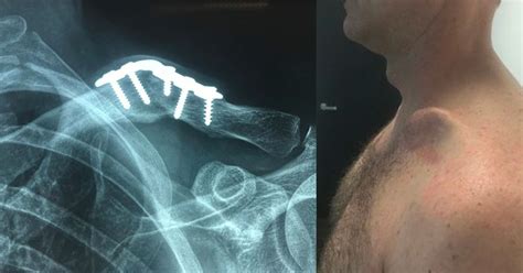 Clavicle Fracture Realignment 20 Years After Original Injury