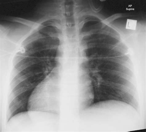 Subsequent Chest X Ray With A Radiopaque Side Marker Download