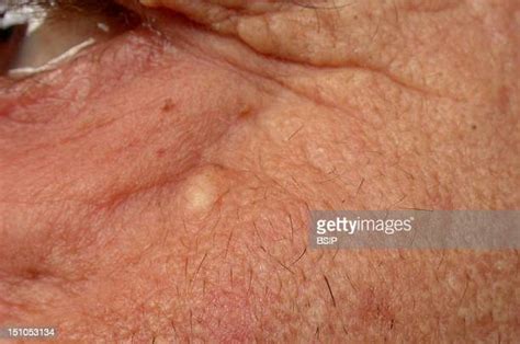 Sebaceous Cyst Foto E Immagini Stock Getty Images