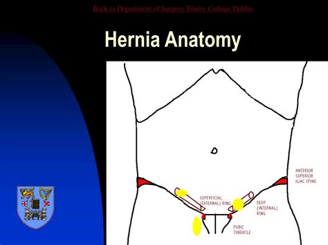 Ppt Abdominal Wall Hernia Powerpoint Presentation Free Download Id