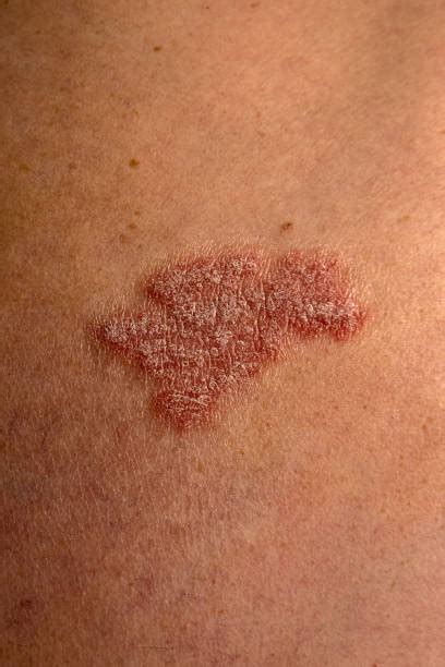 Guttate Psoriasis Stock Photos Pictures And Royalty Free Images Istock