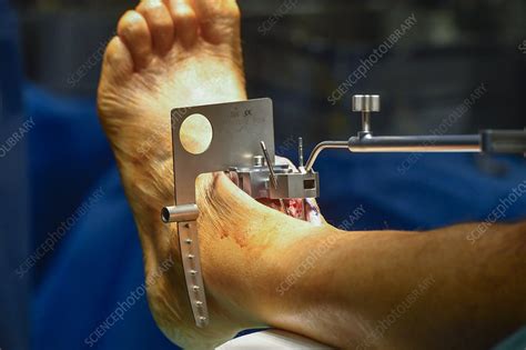 Total Ankle Replacement Surgery Stock Image C0412298 Science Photo Library