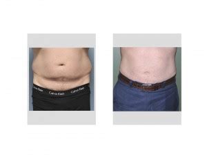 Case Study Liposuction Of The Male Stomach And Love Handles Explore