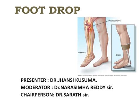 Foot Drop Causes Symptoms And Treatment Ppt