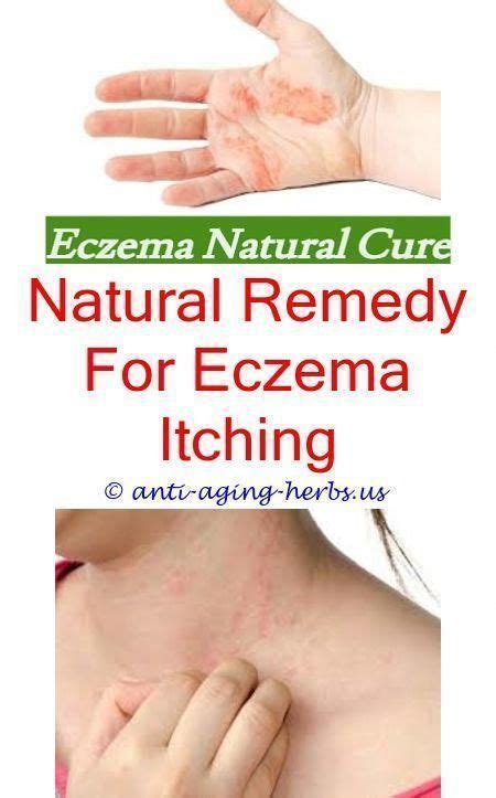 Baby Covered In Eczemahow To Ease Eczemaeczema Cleared