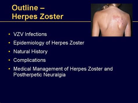 Understanding Herpes Zoster And The Herpes Zoster Vaccine Slides With