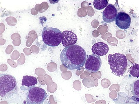 It is rare in the united states, and much. Extranodal NK/T-cell lymphoma - 4.