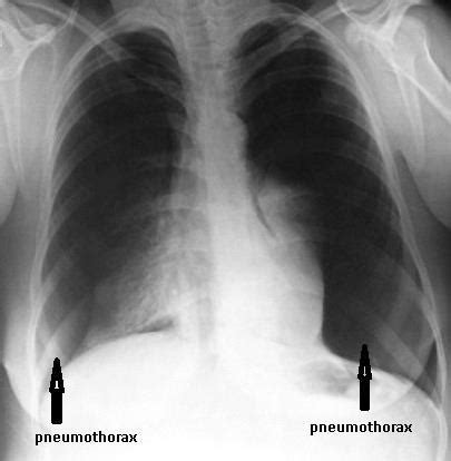 Efficacy determined by receiver operating characteristic. Chest radiograph revealed total pneumothorax in the left ...