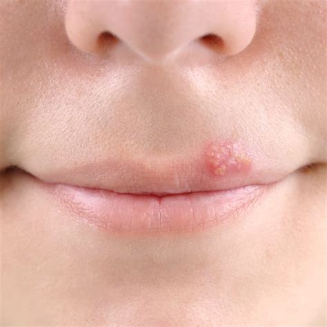 Herpes On Lips Beginning Stages Lipstutorial Org