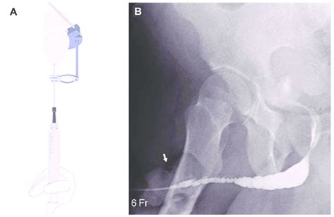 Technique For Retrograde Urethrography A Illustration Showing