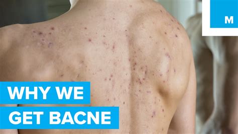 The Science Behind Why “bacne” Happens To Good People Sharp Science
