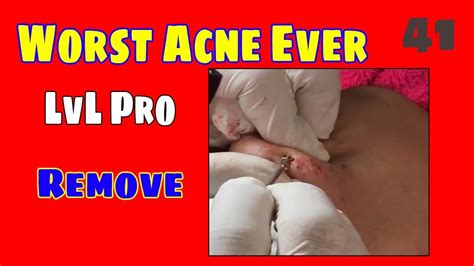 Cystic Acne Treatment Jully 41 How To Remove Hormonal Worst Acne Ever