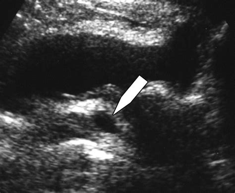 Midline Prostatic Cysts In Healthy Men Incidence And Transabdominal Sonographic Findings Ajr