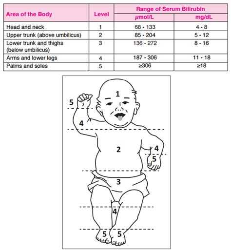 Visual Assessment Of Neonatal Jaundice Kramers Rule Neonatal