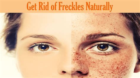 How To Get Rid Of Freckles Without Makeup Mugeek Vidalondon