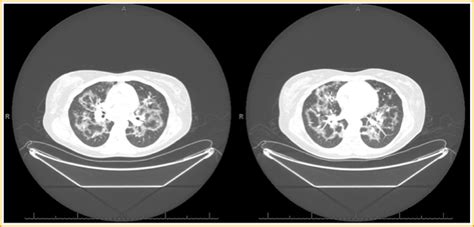 An Atypical And Beautiful Chest Computed Tomography Of Pneumocystis