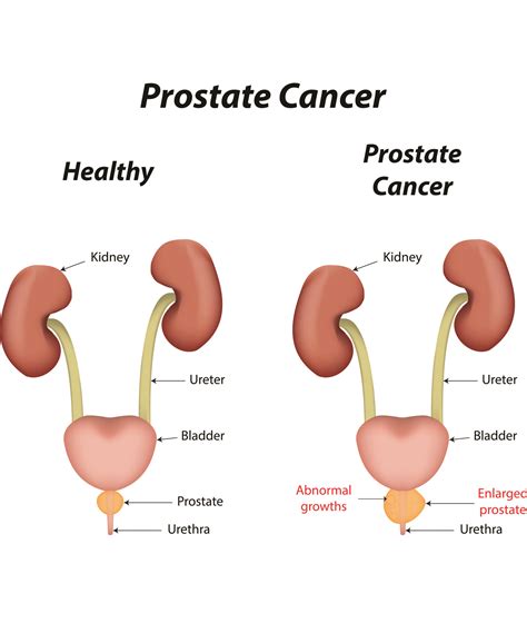 Quick Facts About Prostate Cancer The Post