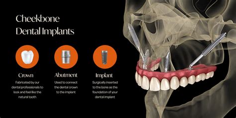 All On 4 Dental Implants Melbourne Dr Jaclyn Wong