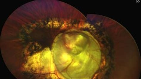 Coloboma Involving The Optic Nerve Retina And Choroid Asrs