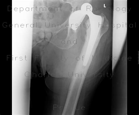 Radiology Case Hip Replacement Dislocation