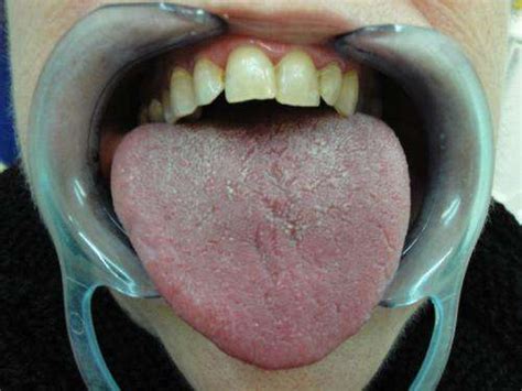 Dry Mouth Syndrome Can Be A Symptom Of Asthma